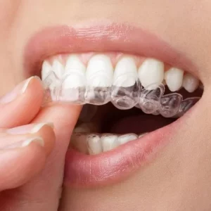 Usynlig tannregulering hos Lille Smil